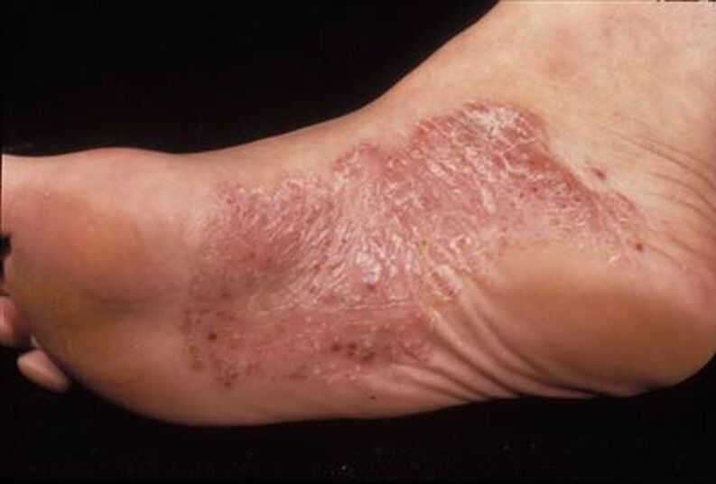 psoriazės simptomai ant pėdų