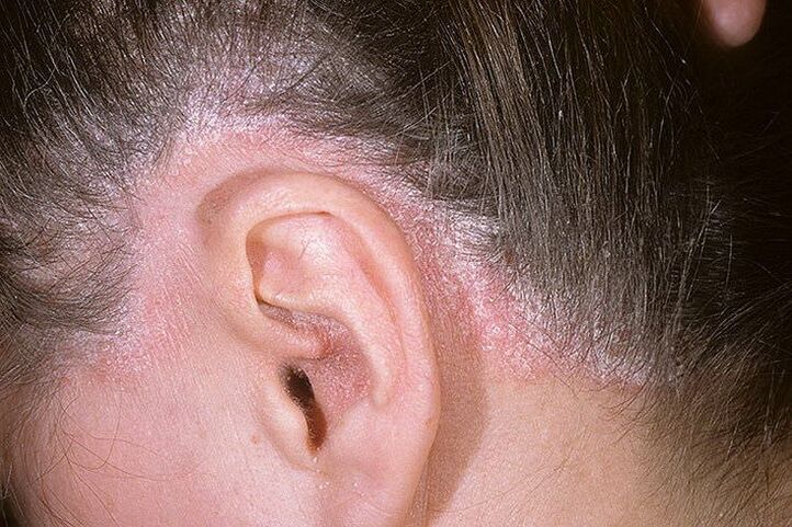 Psoriazės išsiveržimai ant galvos už ausų