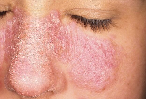 Progresuojanti psoriazės stadija ant veido odos