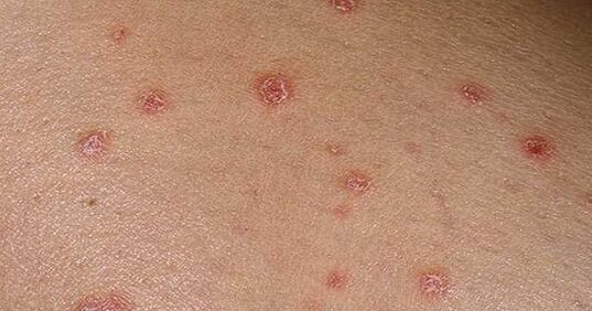 Psoriazinės plokštelės