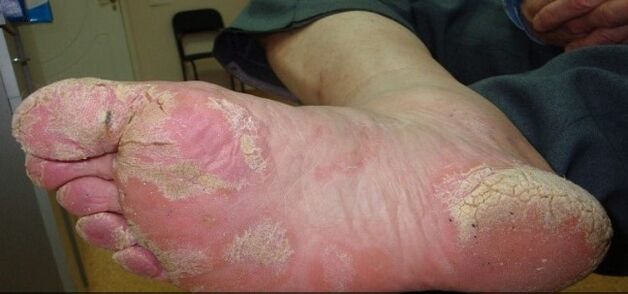 Psoriazė ant kojų