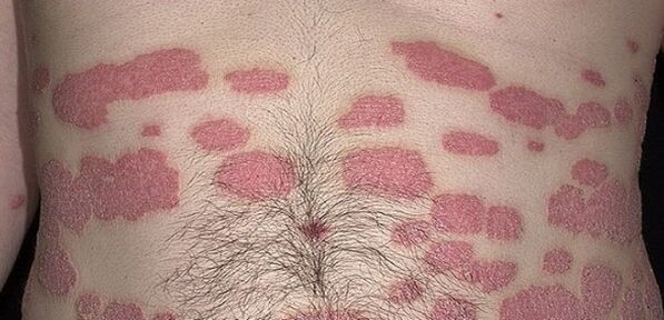 Psoriazė