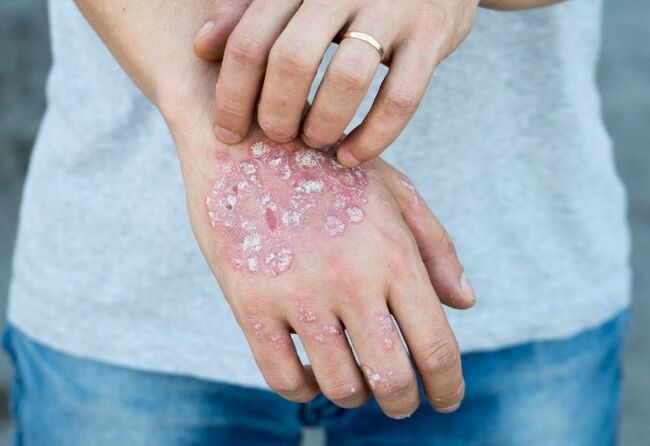 Mesnichhered psoriazė