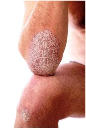 Psoriazė ant alkūnės