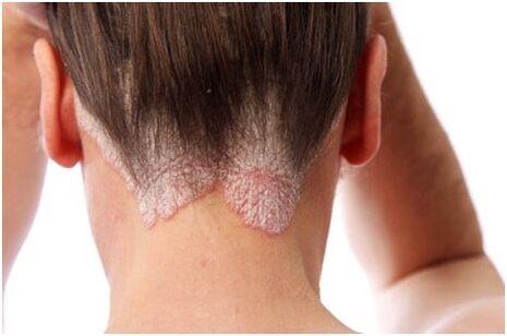 Psoriazė plaukuose