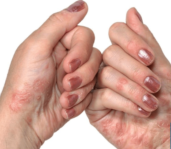 Psoriazė rankose