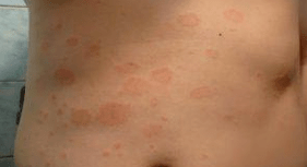 Nelaiminga psoriazė