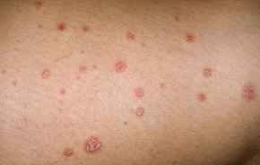 Psoriazinės plokštelės