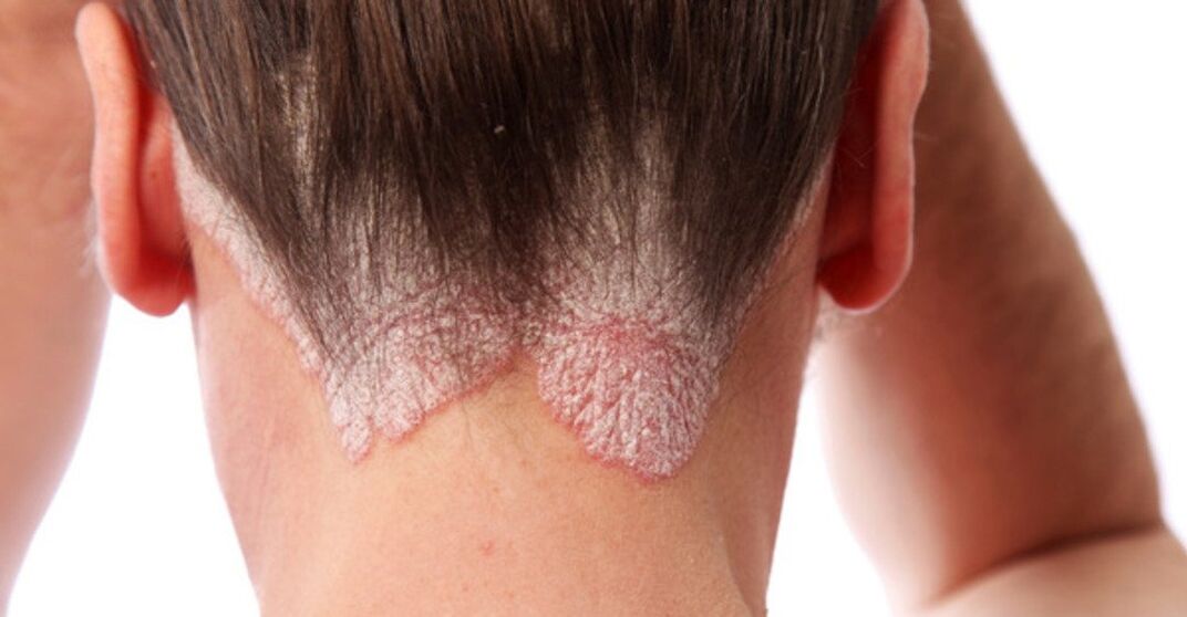 Psoriazė ant mergaičių galvos