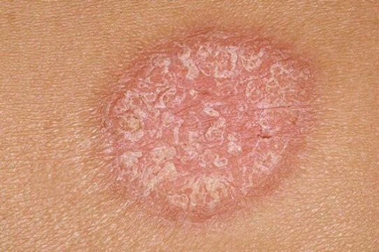 psoriazė