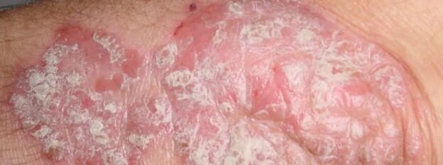 Mesnichered psoriazė