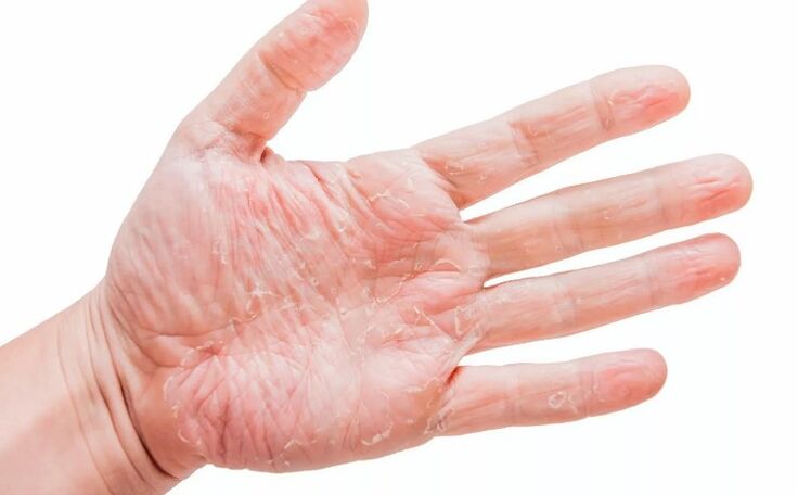 Psoriazė