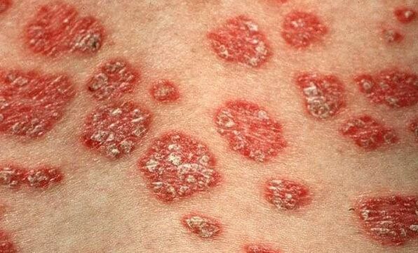 Psoriazės formos