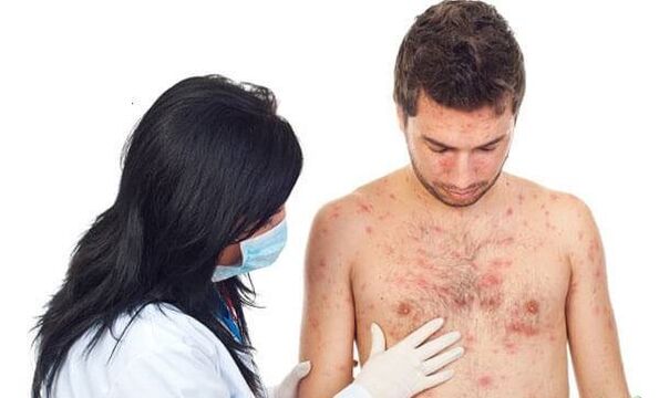 Psoriazės nuotrauka