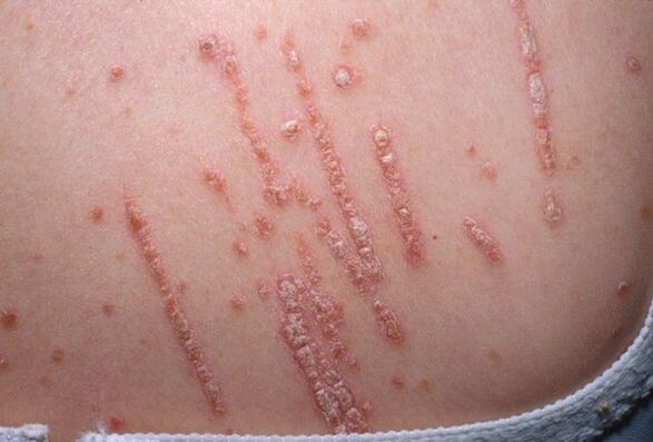 Psoriazė ant kūno