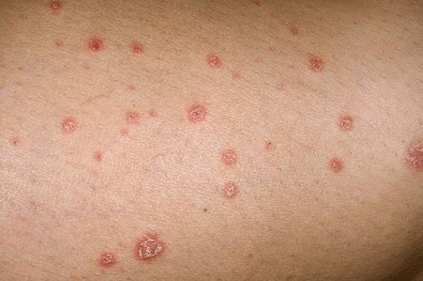 Psoriazinės plokštelės