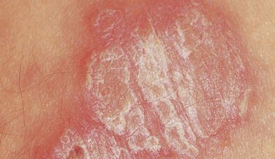 psoriazė