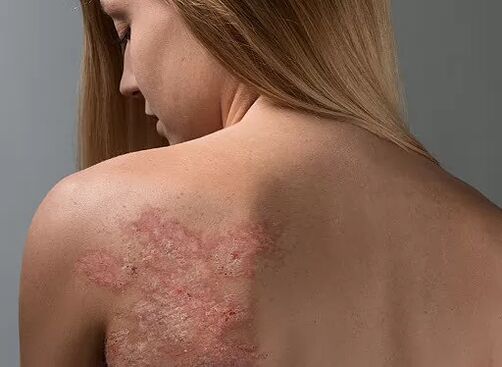 Psoriazė ant merginos nugaros