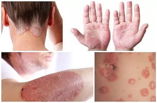 Psoriazės apraiškos įvairiose kūno vietose