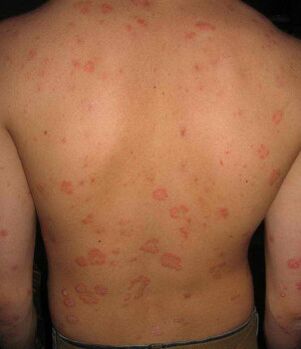 psoriazė ant nugaros