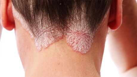 Psoriazinės plokštelės ant galvos odos