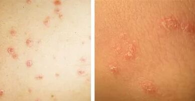 Pagrindinės psoriazės apraiškos