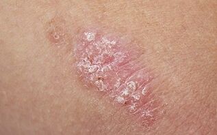 psoriazės priežastys