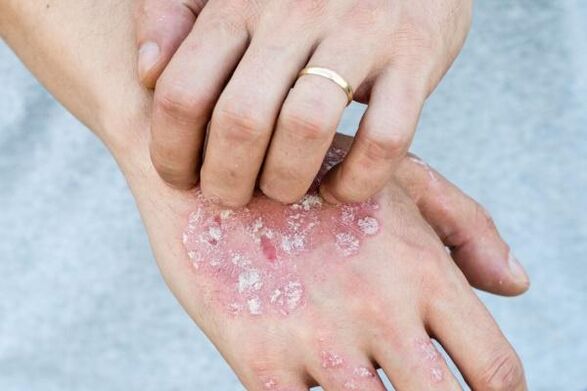 būdingi psoriazės simptomai ant rankų