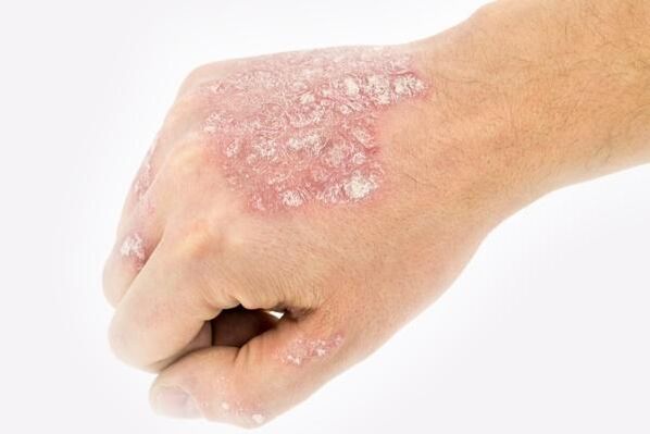 psoriazės atsiradimo ant rankų mechanizmas