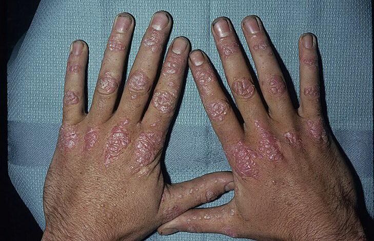 psoriazės atsiradimo ant rankų priežastys