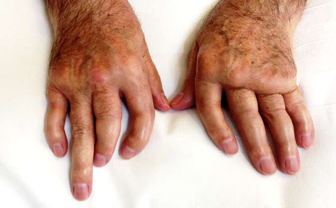 Sutrikęs artritas sergant psoriaze